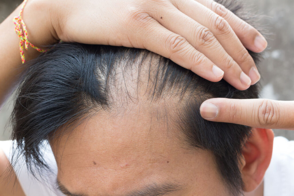 Early Balding in Men: Causes, Prevention, and Treatment